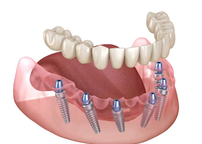 Blog Image