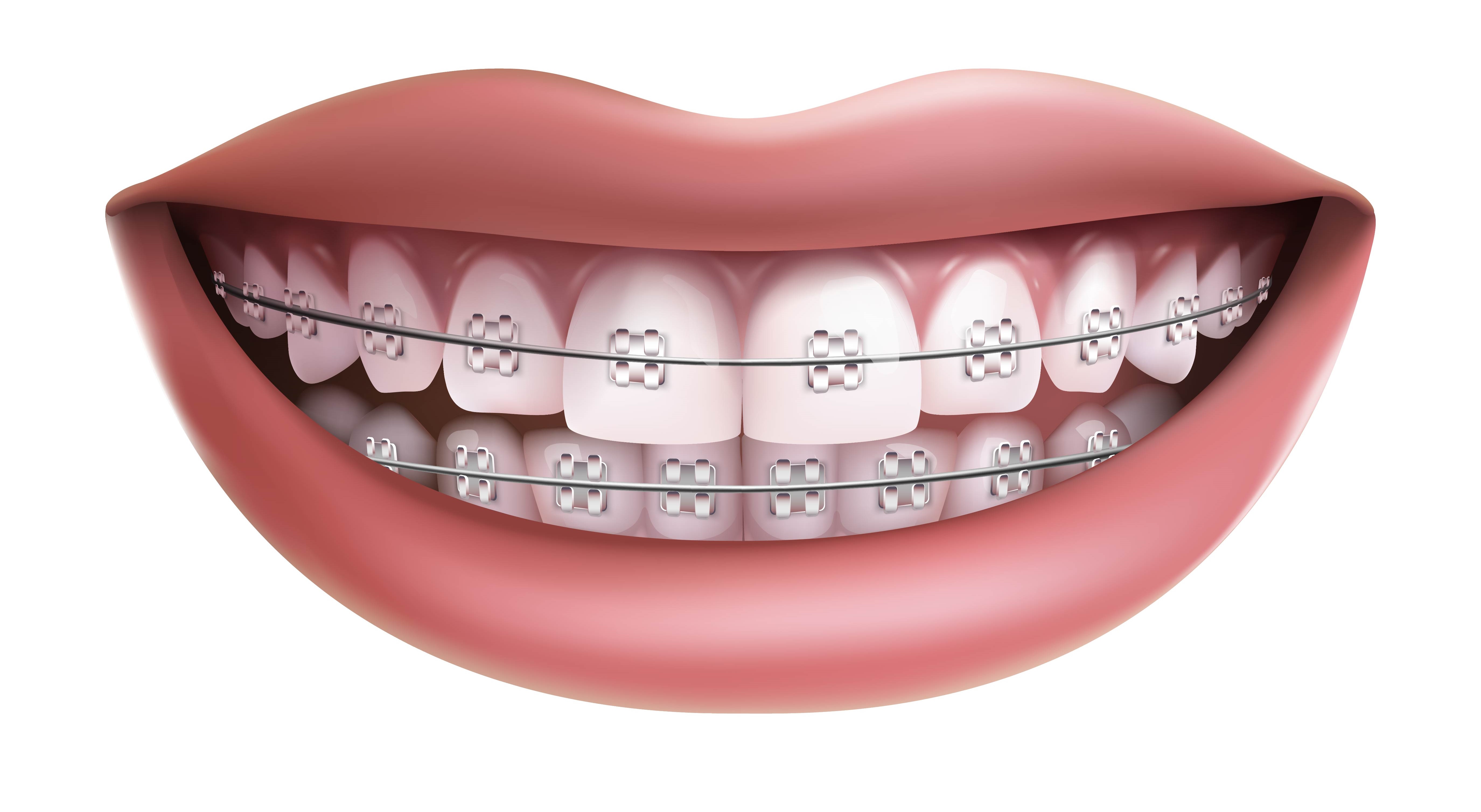 Dental Braces