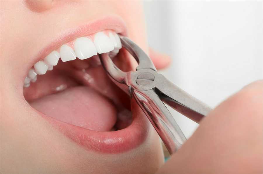 Tooth extraction in Kakinada