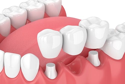 Dental Crown and bridge treatment in kakinada